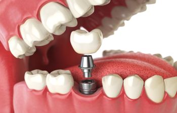 Dental Implant Indian Land, SC