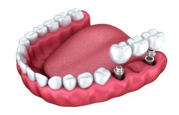 Tooth Replacement Indian Land SC